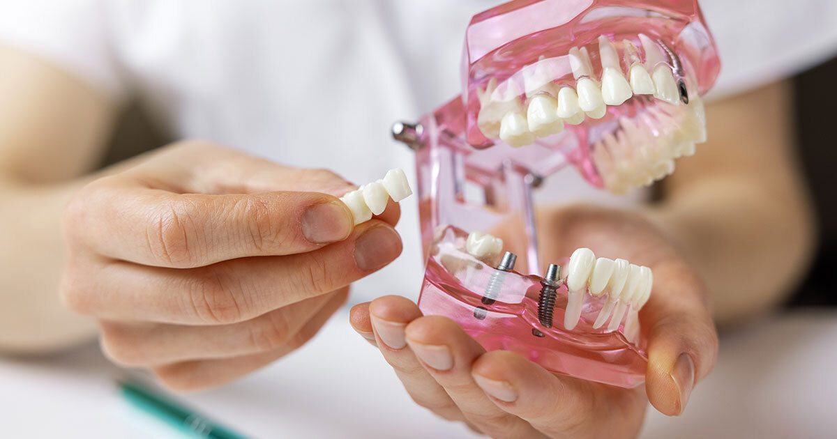 Zahnbrücke: Kosten kalkulieren mit DEM Online-Tool